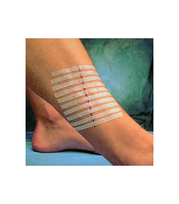 SPARADRAP DE SUTURE- SUTURES CUTANÉES STRIPS – Image 3