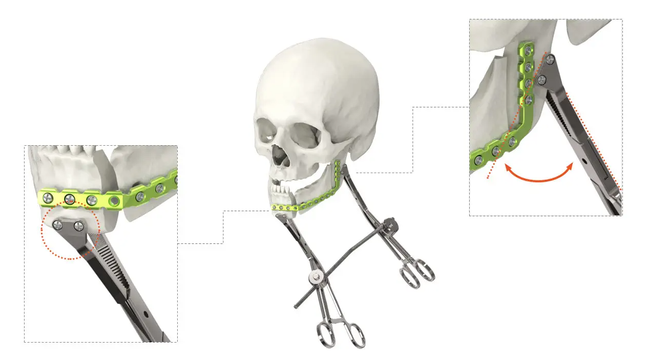 PINCE DE PREHENSION ORTHOPEDIQUE – Image 5
